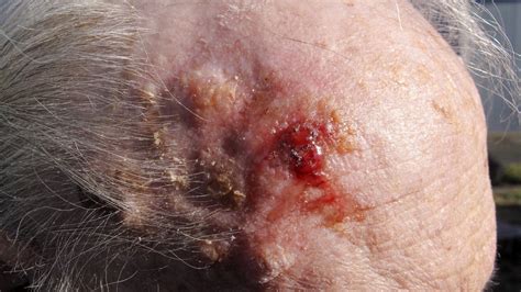 Squamous Cell Carcinoma Early Stages