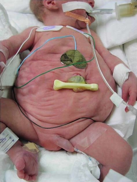 Prune belly syndrome causes, symptoms, diagnosis, prognosis & treatment