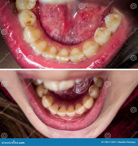 how to get tartar off teeth 7