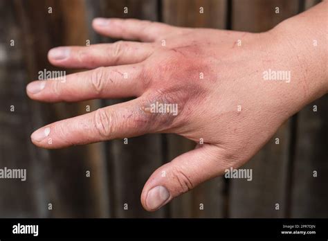 how to treat a first degree burn at home