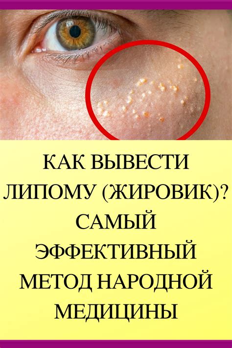 КАК ВЫВЕСТИ ЛИПОМУ (ЖИРОВИК)? САМЫЙ ЭФФЕКТИВНЫЙ МЕТОД НАРОДНОЙ МЕДИЦИНЫ ...