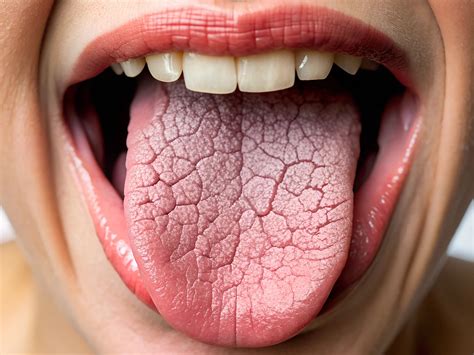 Sintomas De Boca Seca - Boca seca (xerostomia): Causas, sintomas e tratamentos | Oral-B PT
