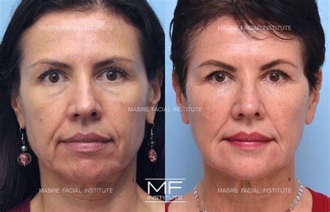 pillow face filler 8