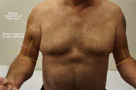 The Hook Test: Don’t Miss A Rupture of the Biceps Tendon at the Elbow! - Shoulder & Elbow