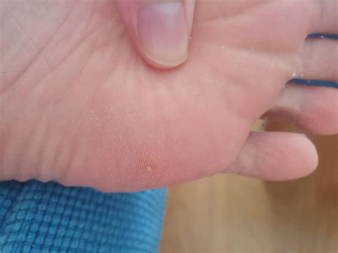 Dr said it was wart, so i applied wart paint now it seems like a corn