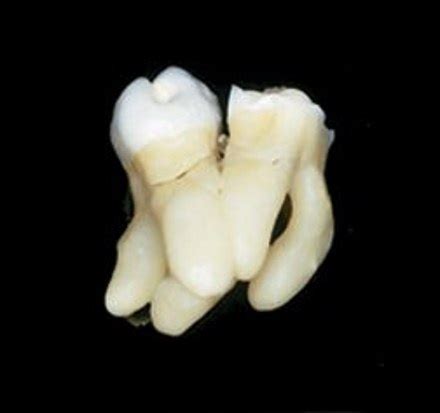 Deformutilation: Concrescence - Tooth Fusion