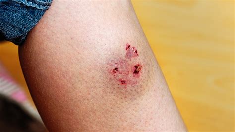 What Should You Do If A Dog Bites You? Tips For When to Get Care - GoodRx