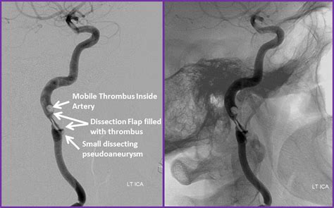 Carotid Artery: Dissection Of Carotid Artery Treatment