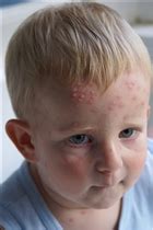 Chickenpox vs. Smallpox - Compare Side by Side | reComparison
