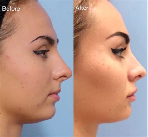 attractive hollow cheeks male female