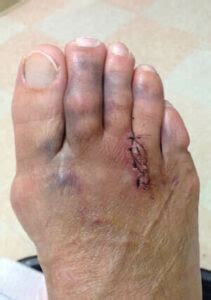 Pain after Morton's neuroma surgery? Failed Morton's surgery? Why ...
