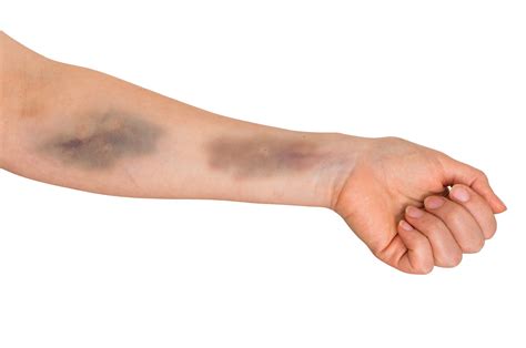 Stop Blowing Veins! How Not to Blow Veins When Starting an IV — The IV Guy