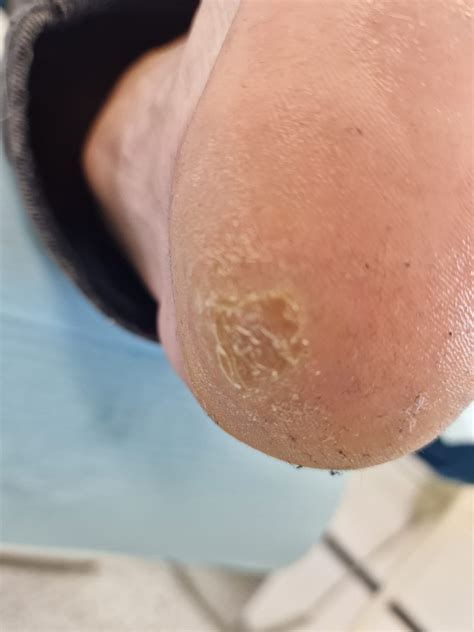 🗯 Verruca plantaris -... - Lucia Kaštierová - Podomedical