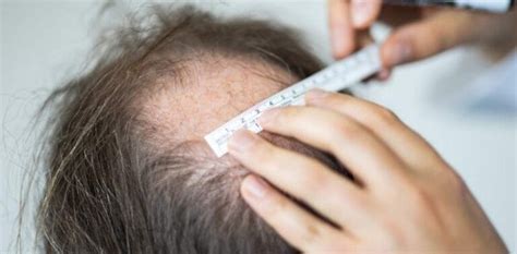 hair transplant journey expectations  insights