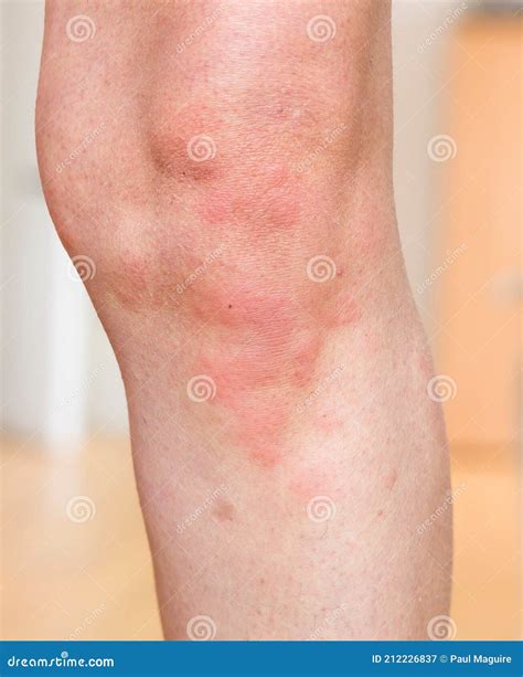 Hives Rash Urticaria, Skin Condition, Skin Allergy on Body, UK Stock