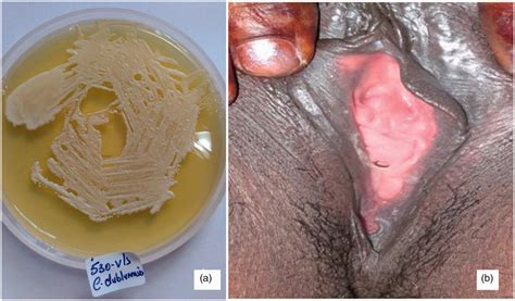 Vulvovaginale Candidiasis Afscheiding