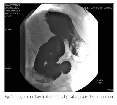 Una causa infrecuente de obstrucción intestinal en el adulto