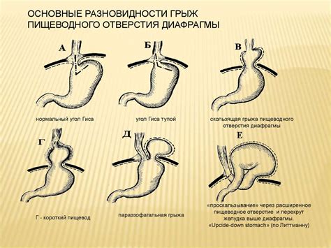 Грыжи живота - презентация онлайн