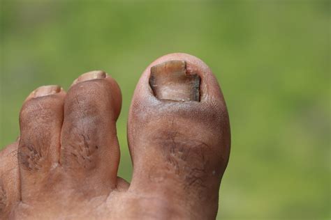 Green Toenail Fungus - Natural Wire
