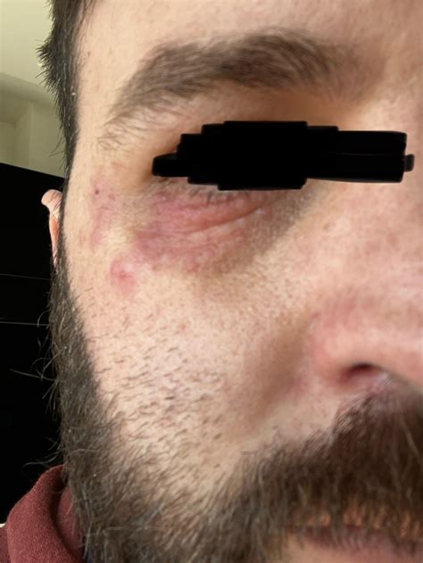Hoping to help others – My experience with Perioral Dermatitis and