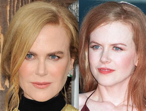 Nicole Kidman's Plastic Surgery Regret: See Her Frozen Face Before and ...