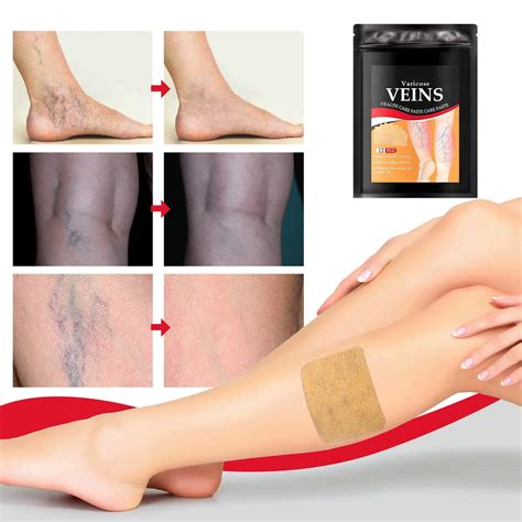 Varicose Veins Treatment Patch — Gear Elevation