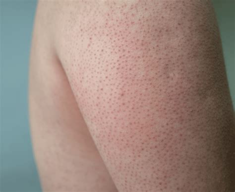 Effective Keratosis Pilaris Treatments | Advanced Dermatology