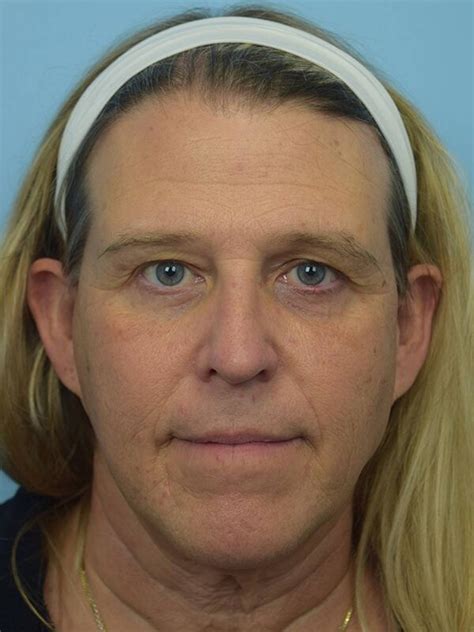 fat transfer to the face before and after 4