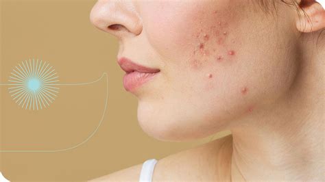 Mapa das espinhas: O que a localização facial revela? | Intua Beauty