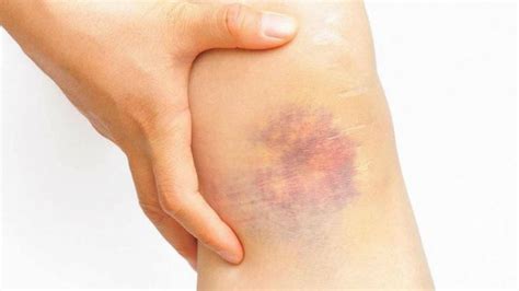 mati mati percaya lebam tiba tiba  badan disebabkan digigit syaitan