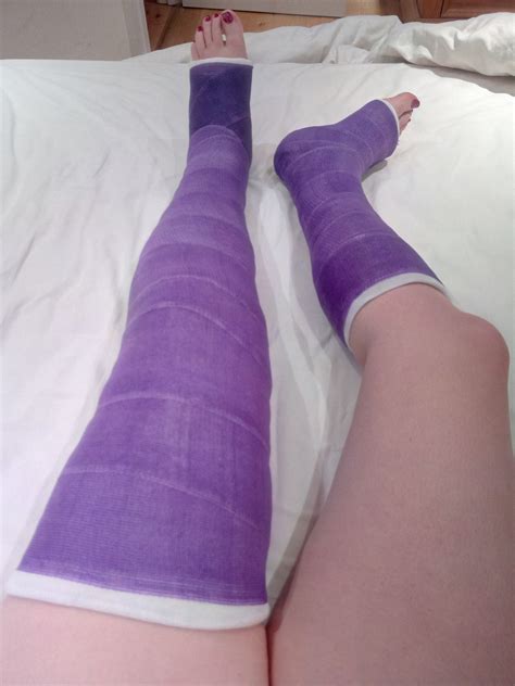 long leg cast | Tumblr