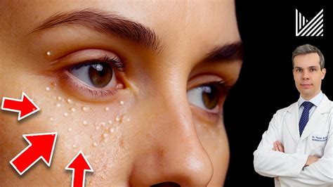Milium: O Que Causa e Como Remover essas Bolinhas do Rosto SEM DOR ...