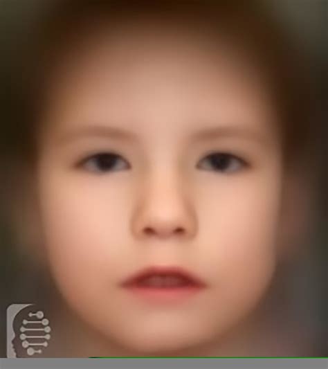 Mobius Syndrome / Moebius Poland Syndrome A Case Report : Residents and