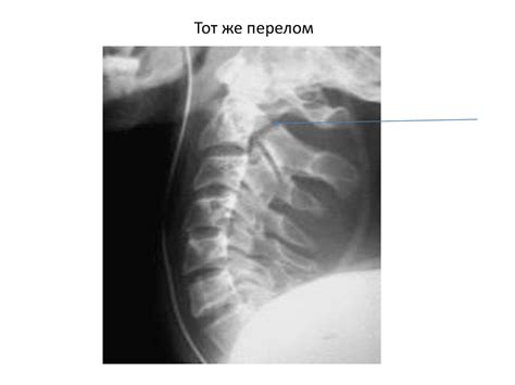 Повреждения позвоночника - презентация онлайн