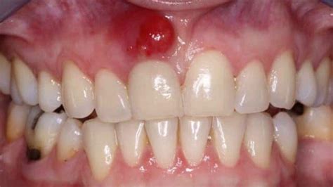 understanding tooth infection   treatment options