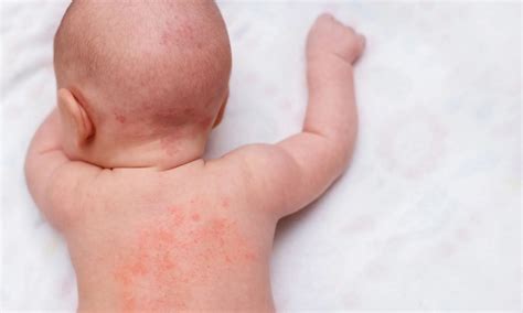 mild atopic dermatitis