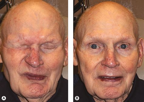 Abnormal Movements of the Face - Clinical Tree