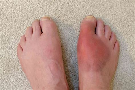 Bump on Toe: Causes and Treatments