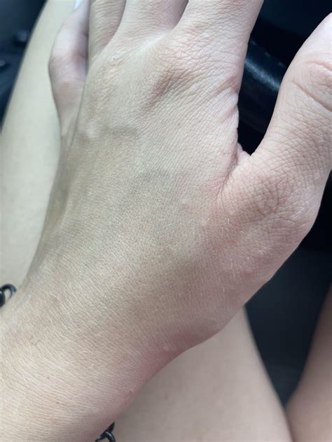 HELP identify this mystery rash : r/DermatologyQuestions