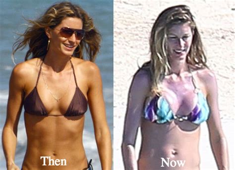 Gisele Bundchen Plastic Surgery Before and After Photos