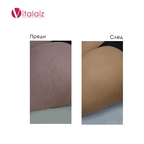 Ефективни Процедури за Премахване на стрии - Vitalaiz Бургас