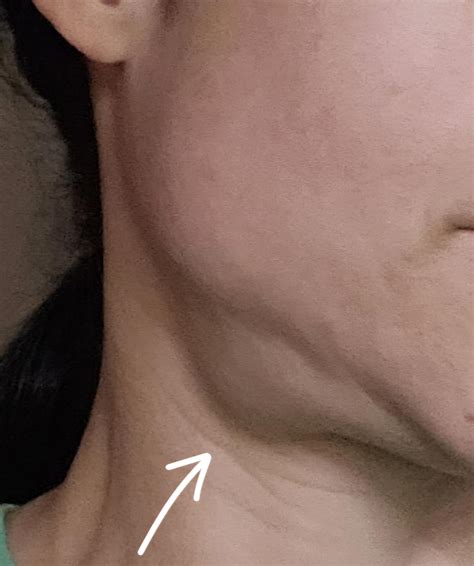 What could this be? Swollen lymph nodes? : r/medical