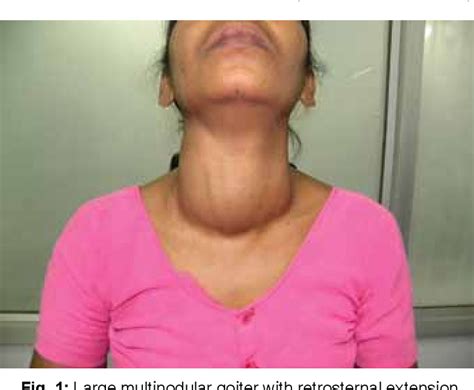 Figure 1 from Pemberton Sign in Diagnosis of Retrosternal Goiter ...