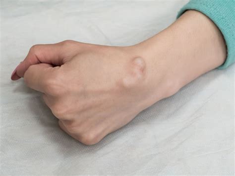 ganglion cyst   wrist
