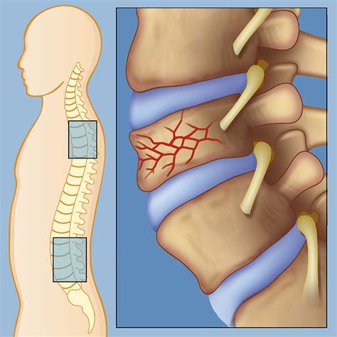 Spinal Compression Fractures | Weill Cornell Brain and Spine Center