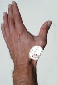 thumb joint replacement restoration plastic surgery dr mitch