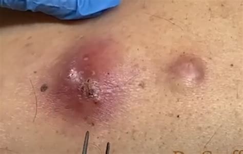 Two Cysts on Back Incision and Drainage - New Pimple Popping Videos