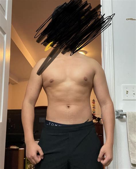 What to expect with recovery from Gyno surgery? : r/gynecomastia