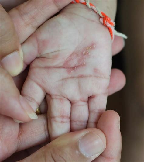 scabies symptoms pictures treatment  scabies   itchy