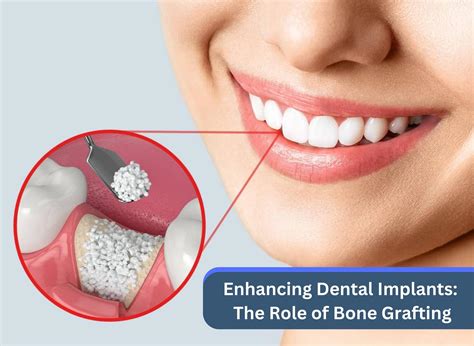 Enhancing Dental Implants: The Role of Bone Grafting
